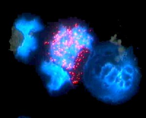Gene Therapy